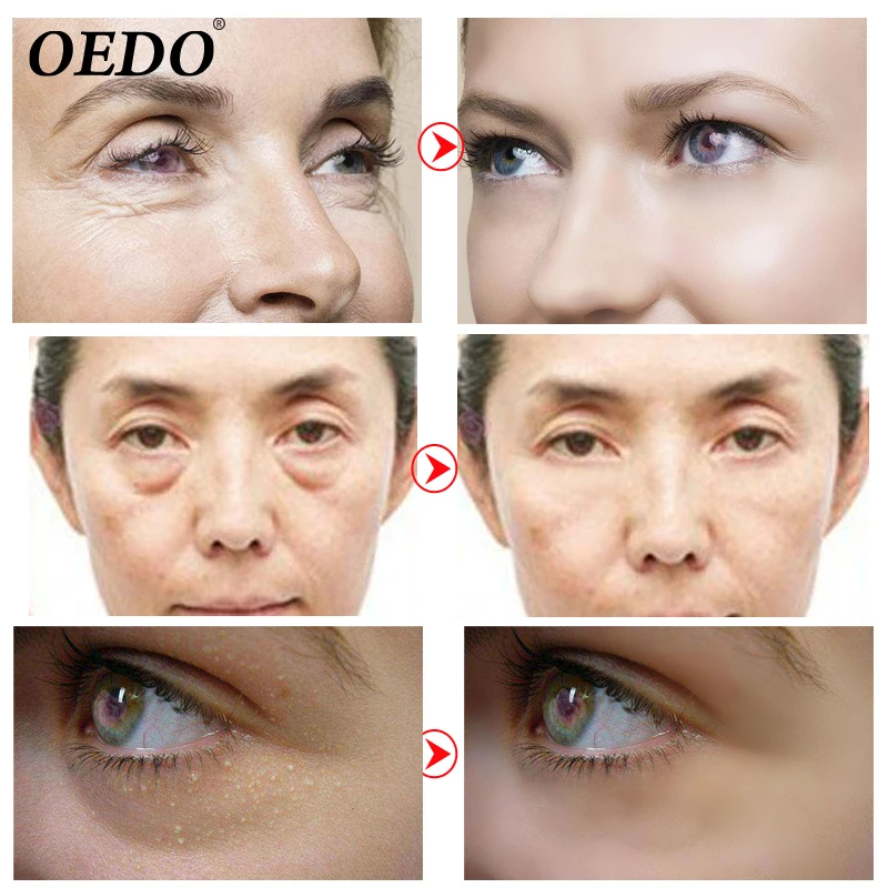tipuri de îngrijire a ochilor anti-îmbătrânire